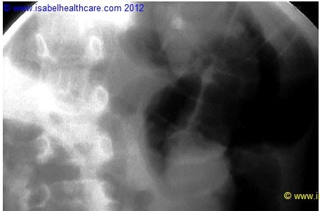 Intussusception 2 Image