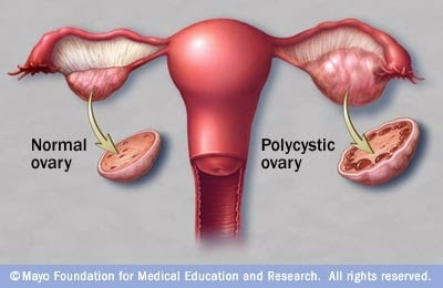 PCOS-image.jpg