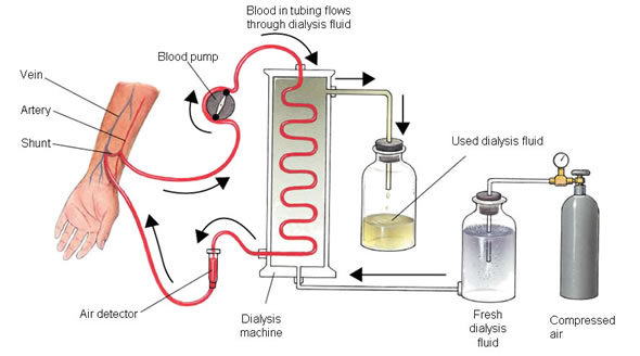 dialysis.jpg