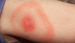 lyme-disease-rash.png