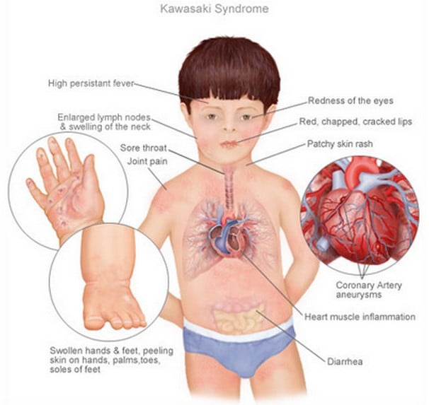 1 Minute Read, Kawasaki Disease